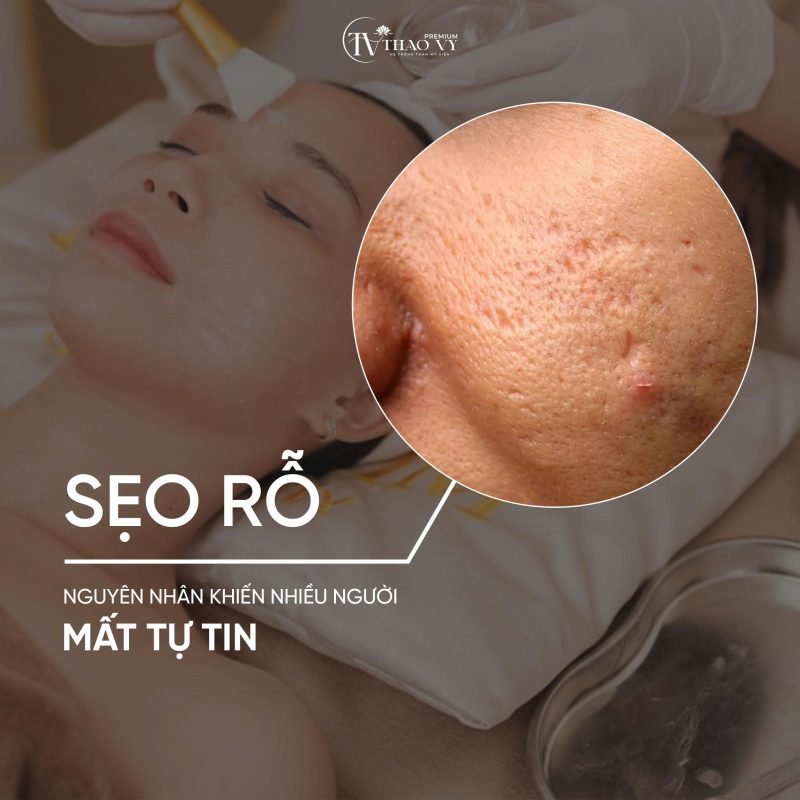 Nguyên nhân gây sẹo rỗ khiến nhiều người mất tự tin