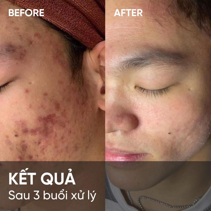 Kết quả sau 3 buổi xử lý sẹo rỗ tại Thẩm Mỹ Viện Thảo Vy
